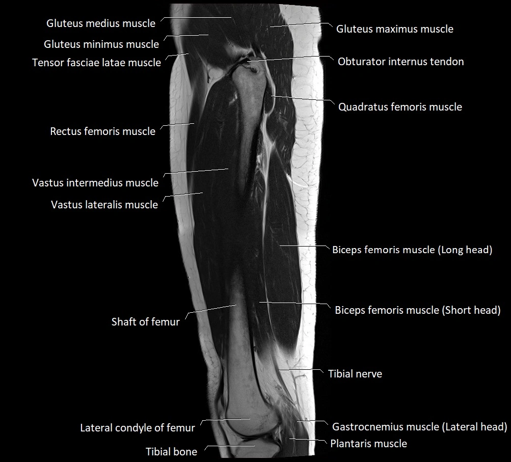 Thigh sagittal cross sectional anatomy MRI 3T image 7.webp